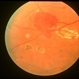 Retinal Capillary Hemangioma Retinal Capillary Hemangioma